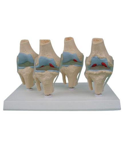 四阶段病变膝关节模型