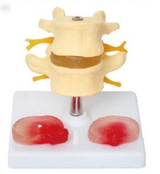 两节腰椎带两个病变椎间盘模型