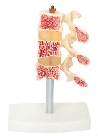 骨质疏松症模型