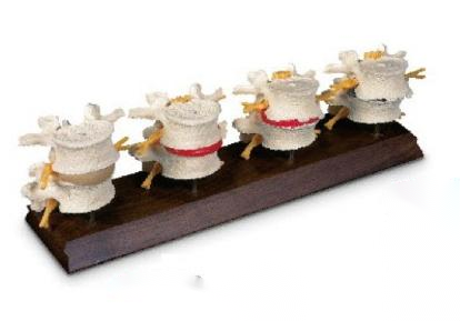 四阶段病变腰椎模型