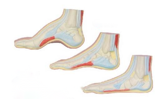 足弓模型