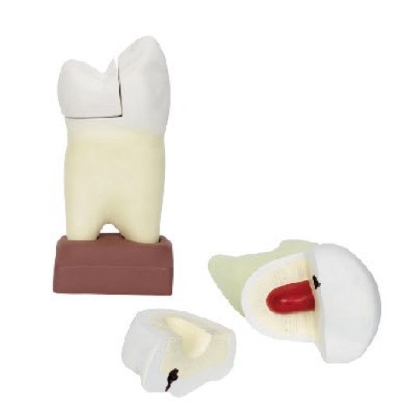 上颌两根龋齿解剖模型(2部件)
