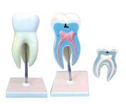 臼齿带龋齿模型
