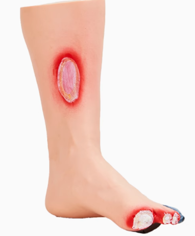 糖尿病足护理模型