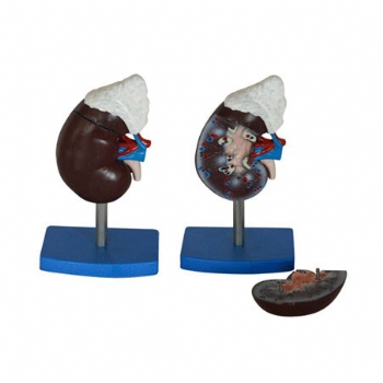 肾脏与肾上腺放大模型